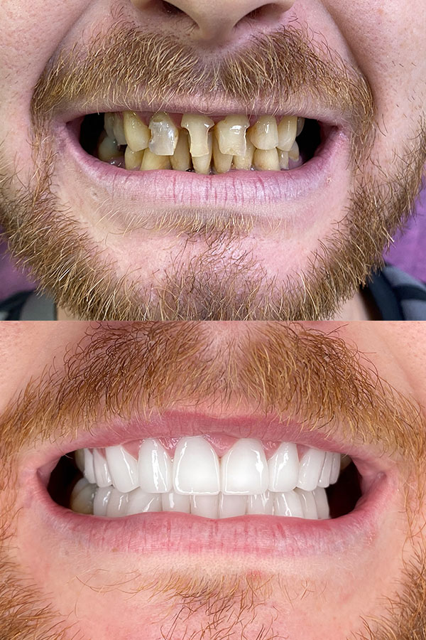 How to get zirconia crowns? Dental Estetik