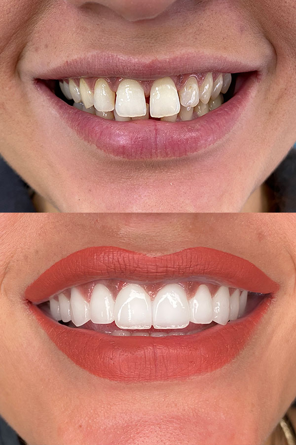 What is a Zirconia Crown? Dental Estetik